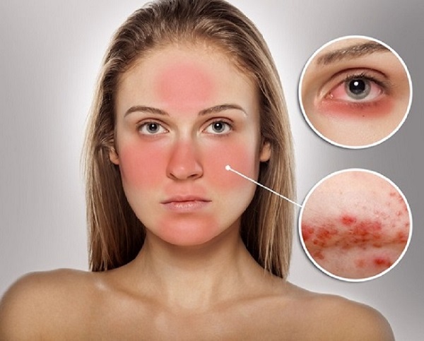Da mụn nhạy cảm là làn da có mụn và dễ bị kích ứng, căng đỏ và có thể gây cảm giác khó chịu